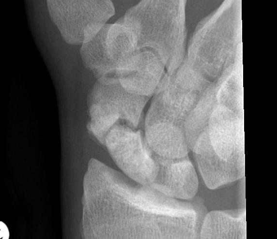 Scaphoid Non union